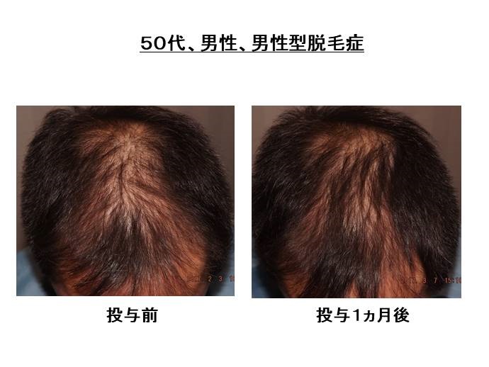 円形脱毛症　病院""